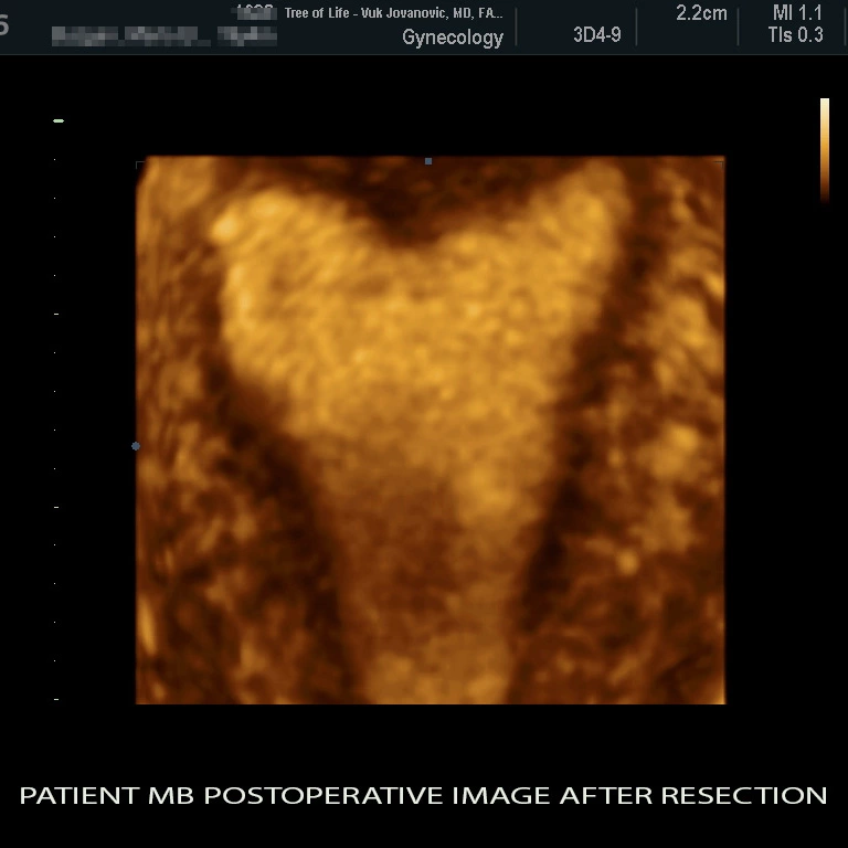 uterine septum img