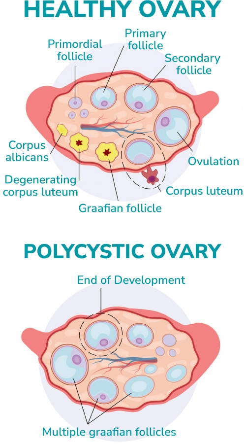 PCOS-Symptome und Behandlung des polyzystischen Ovarsyndroms